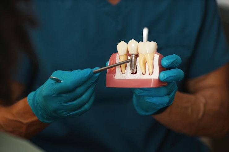 A dentist wearing blue gloves demonstrates a dental implant procedure using a tooth model, pointing to the implant fixture placed between adjacent teeth to explain the implant restoration process.